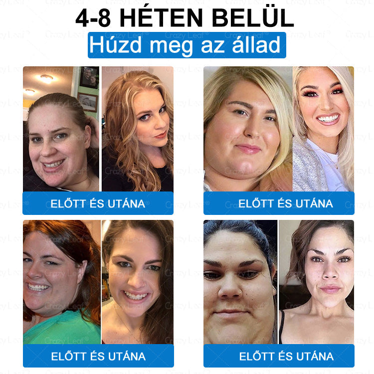 Klinikailag igazolt|Hivatalos webáruház|𝐶𝑟𝑎𝑧𝑦𝐿𝑒𝑎𝑓® SMGT- GLP-1 Nano mikrotüs, vékonyés erős tapasz|Célzott hatás elhízás, megereszkedett bőr, magas vérnyomás, cukorbetegség, zsírmáj, ízületi fájdalmak, testi fájdalmak és egyéb panaszok esetén