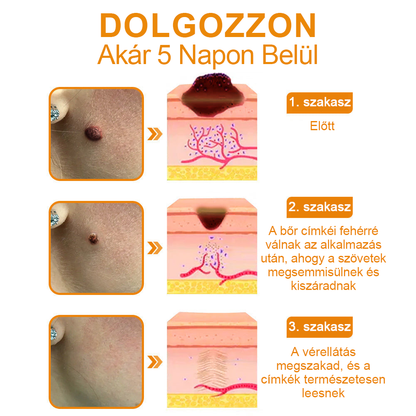 Vsoxa™ méhméreg szemölcs és anyajegy eltávolító krém (Utolsó napi akció, 80% kedvezmény)