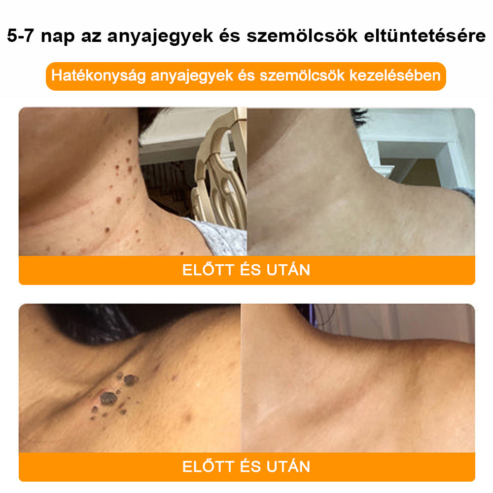 🌸🌞[✨Hivatalos Márka Bolt✨] 𝑻𝒖𝒓𝒐𝒏𝒖™ Gyógynövényes és szemölcskezelő krém (👨‍⚕️Orvosok ajánlása)