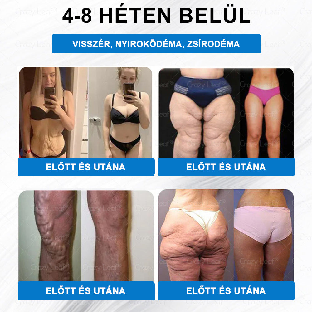 Klinikailag igazolt｜Hivatalos webáruház｜𝐶𝑟𝑎𝑧𝑦𝐿𝑒𝑎𝑓® SMGT- GLP-1 Nano mikrotüs, vékonyés erős tapasz｜Célzott hatás elhízás, megereszkedett bőr, magas vérnyomás, cukorbetegség, zsírmáj, ízületi fájdalmak, testi fájdalmak és egyéb panaszok esetén